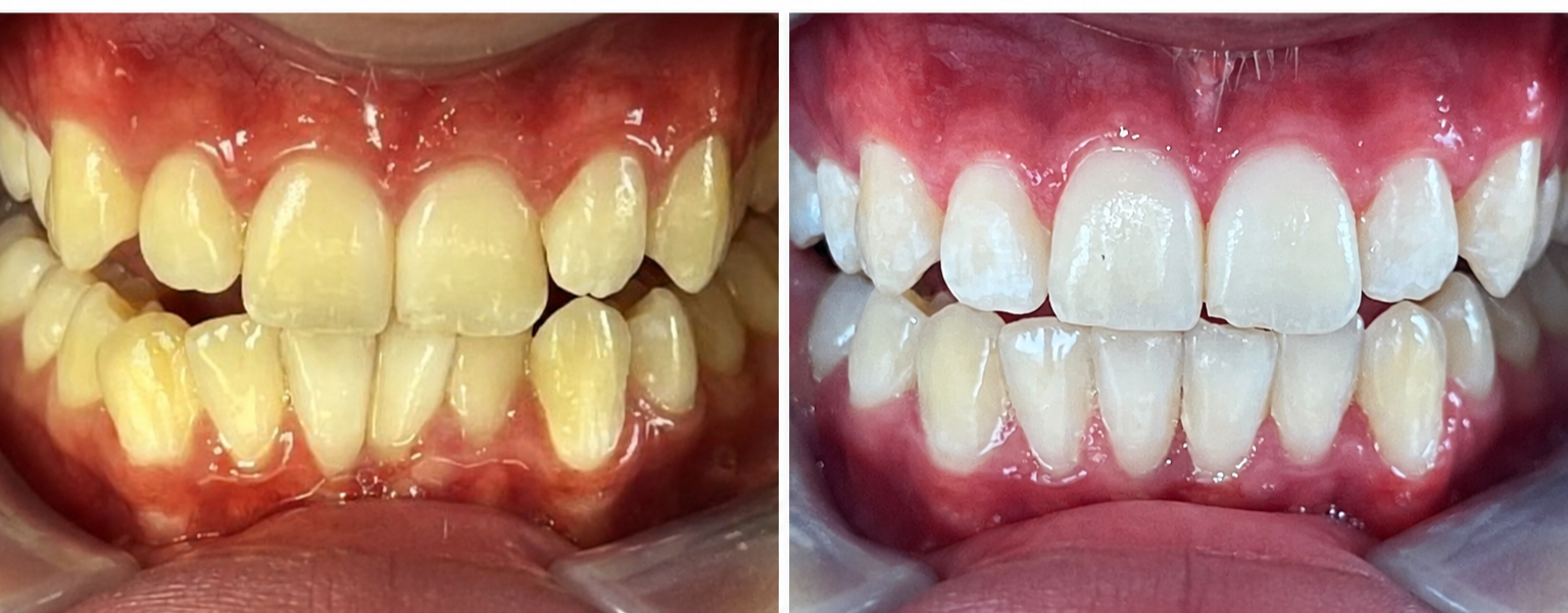 Invisalign before & after — Crowding